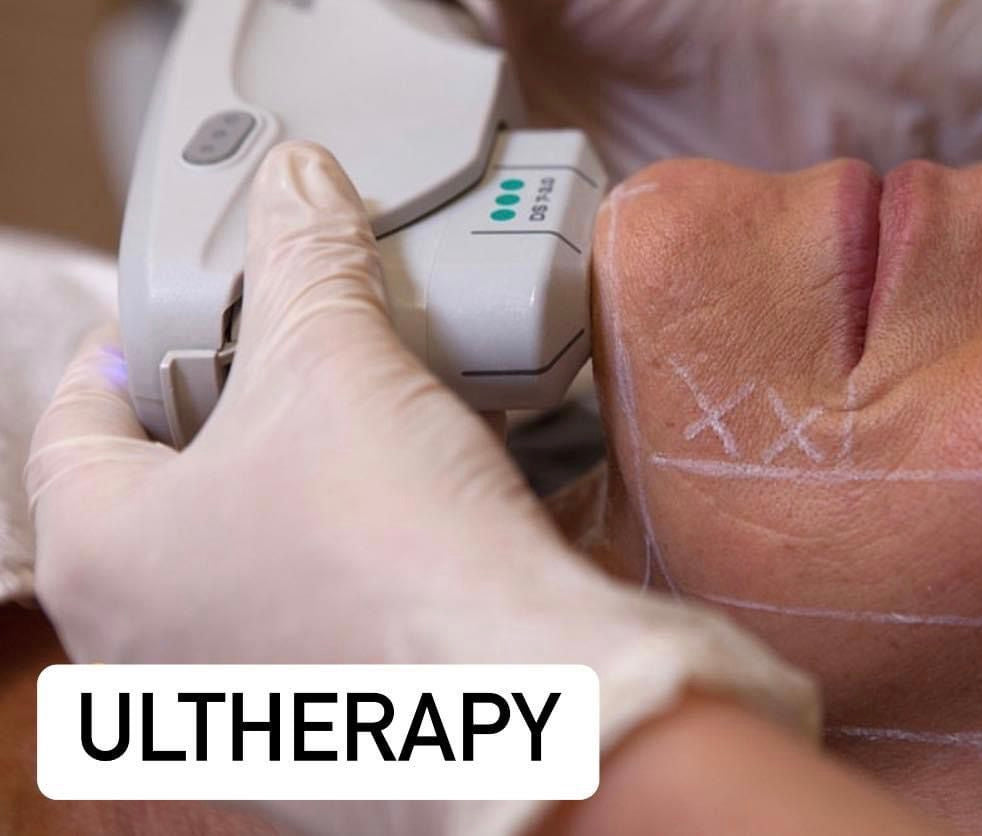 Ultherapy Cuello y Escote